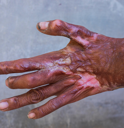 Severe Burn Injuries