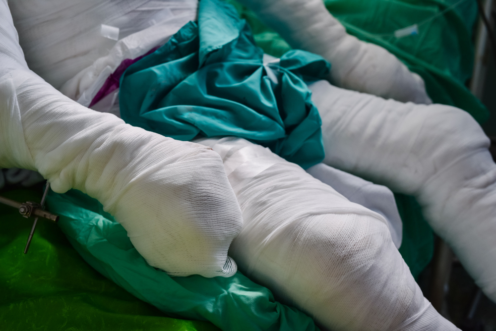 Patient with burns in the hospital.