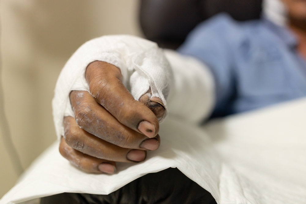 Patient with burns wound in burn unit at the hospital.