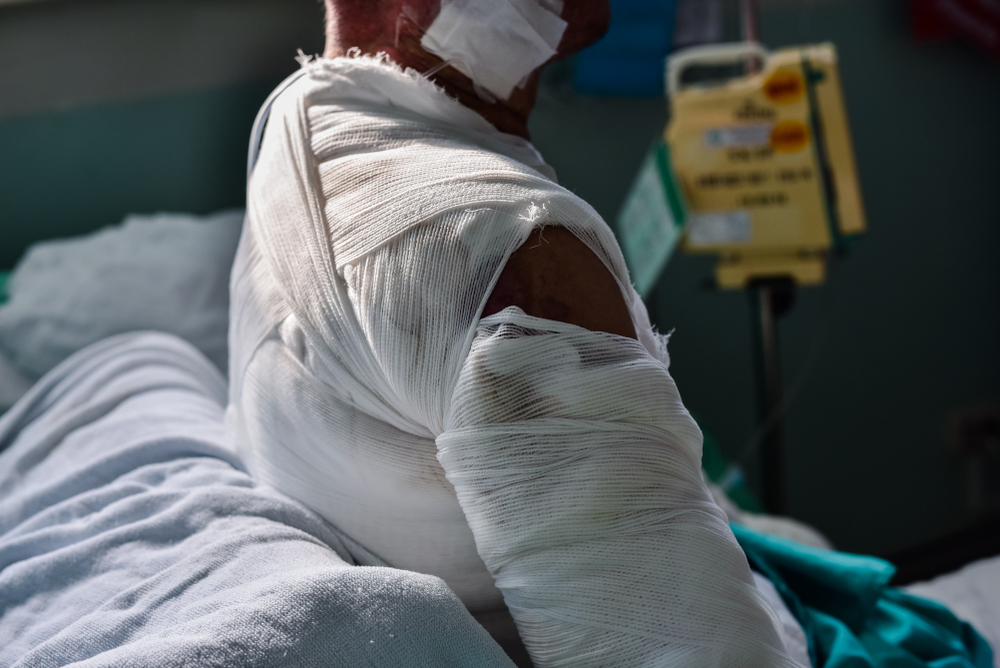 Patient with burns wound in burn unit at the hospital.