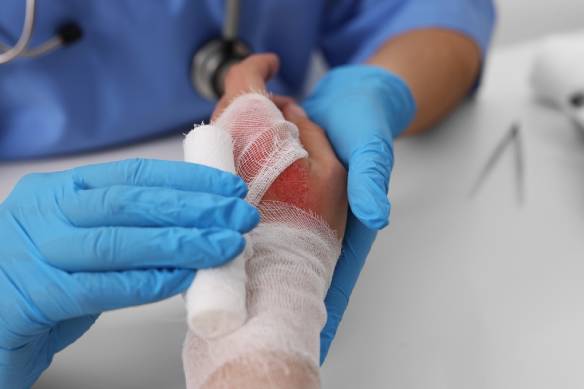 Doctor bandaging patient's burned hand at table