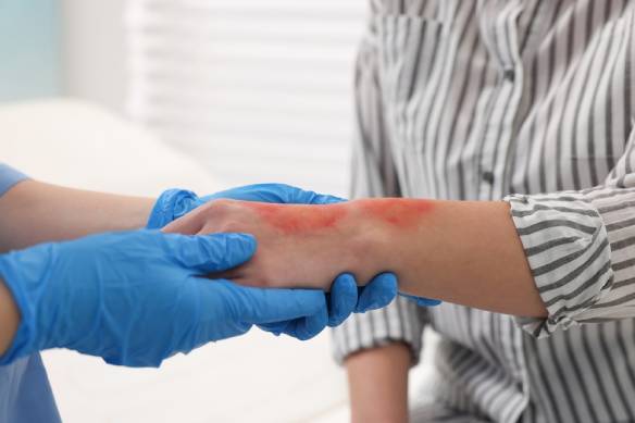 Doctor examining patient's burned hand indoors