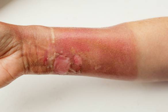 woman's hand with a burned skin of boiling water